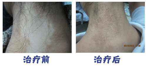 女性有白癜风会遗传给孩子吗