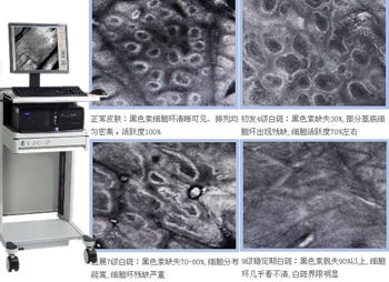 身上有白斑 五一做个白斑检查